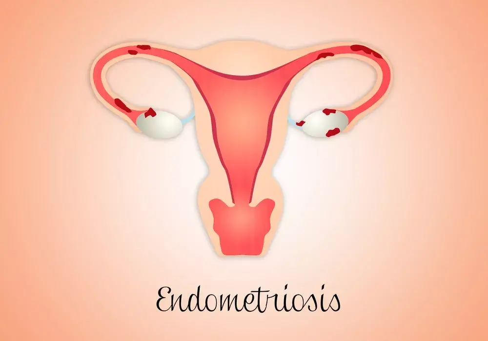 子宫内膜异位症:打针,手术,放环? 子宫内膜异位症:打针,手术,放环?