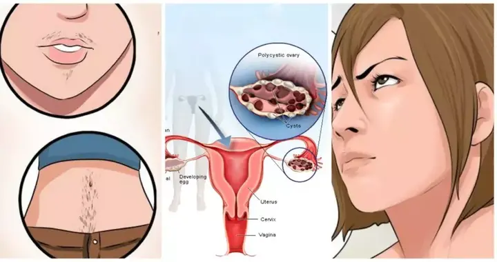 多囊卵巢综合症的药物和辅助生殖治疗