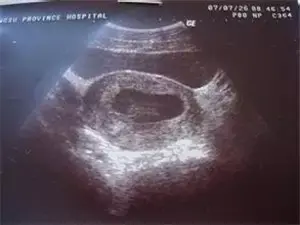 早孕期怎样监测血清HCG