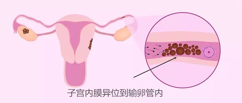 子宫内膜异位症:打针,手术,放环? 子宫内膜异位症:打针,手术,放环?