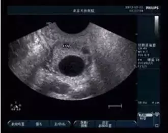 卵泡成熟后不破裂是怎么回事? 卵泡成熟后不破裂是怎么回事?