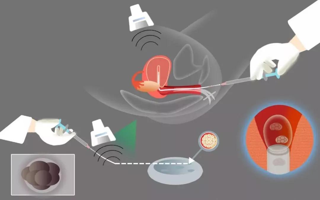 “试管婴儿”冻胚移植的三种方案 “试管婴儿”冻胚移植的三种方案