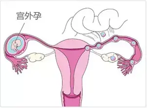 宫外孕还有“双胞胎”?这是怎么一回事? 宫外孕还有“双胞胎”?这是怎么一回事?