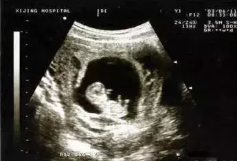 怀孕早期出血,宝宝会怎样? 怀孕早期出血,宝宝会怎样?