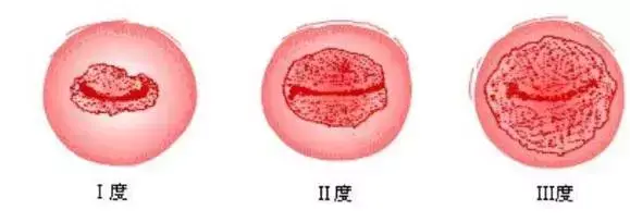 怀孕早期出血,宝宝会怎样? 怀孕早期出血,宝宝会怎样?