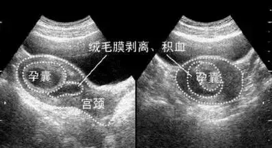 怀孕早期出血,宝宝会怎样? 怀孕早期出血,宝宝会怎样?