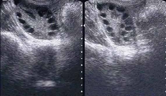 关于多囊，你不得不知道的6个问题
