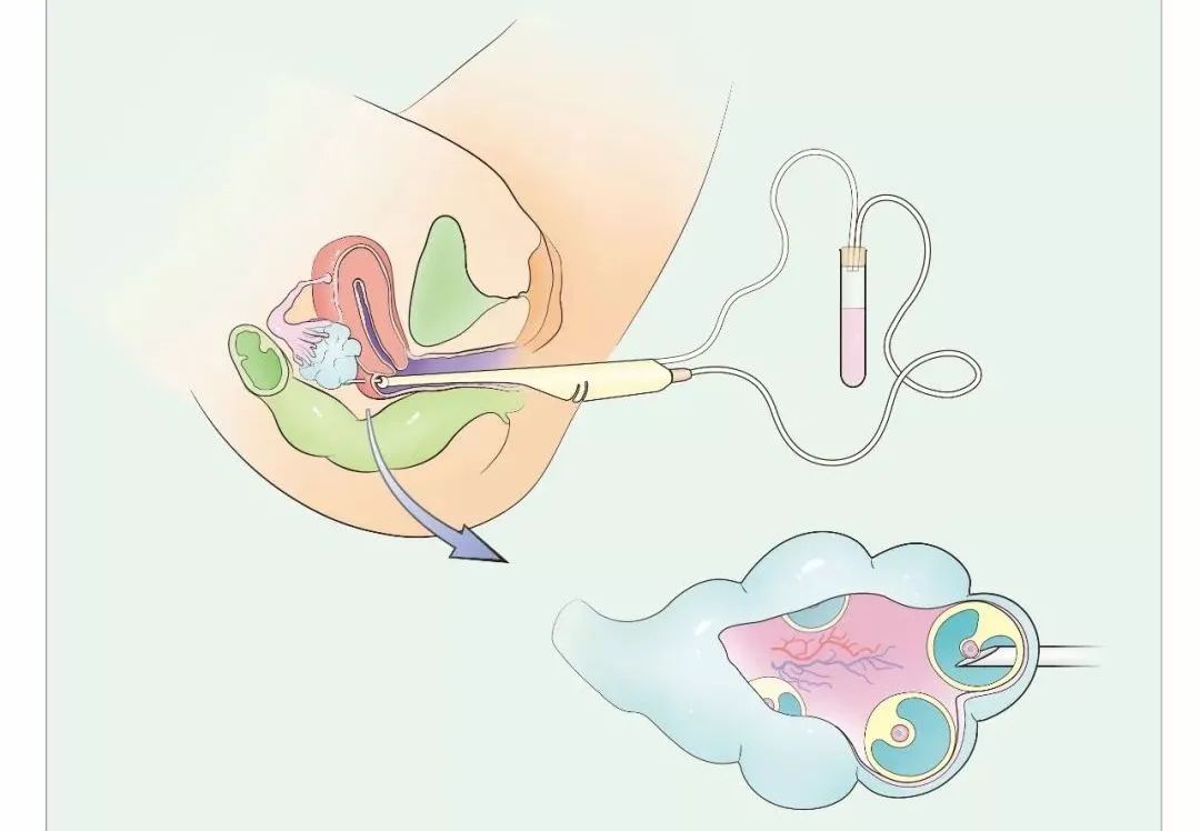 什么是经阴道穿刺取卵术？