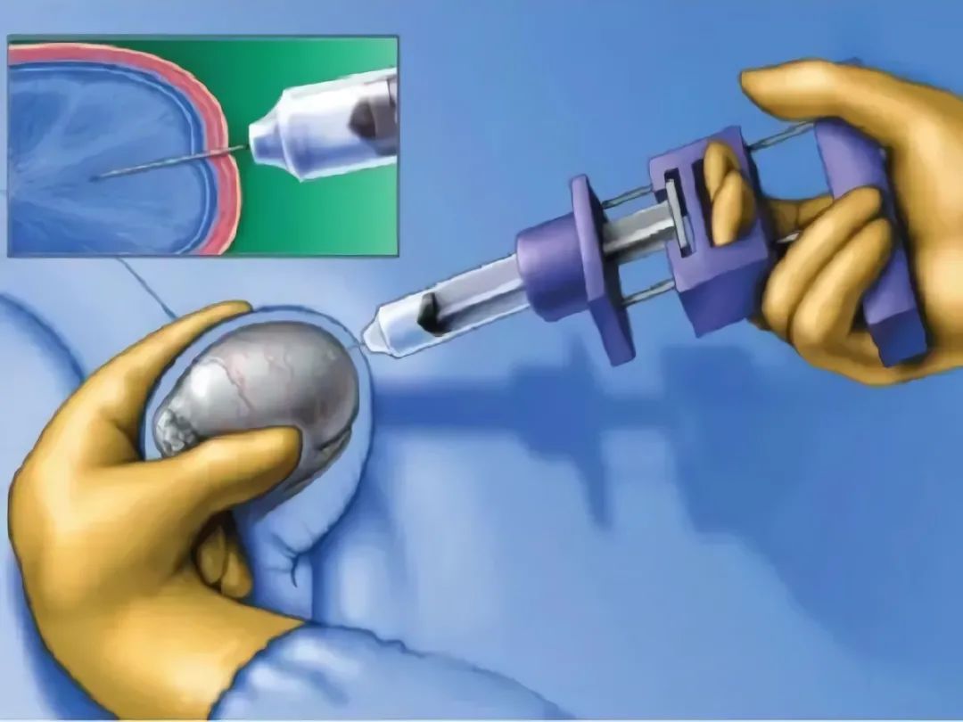 什么是体外受精-胚胎培养? 什么是体外受精-胚胎培养?