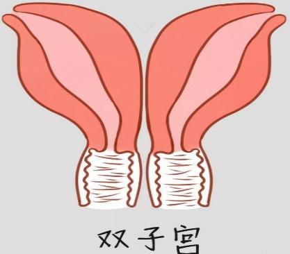 子宫畸形对妊娠有什么影响? 子宫畸形对妊娠有什么影响?