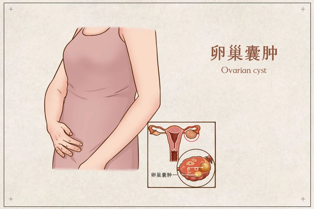 孕期卵巢囊肿注意事项是什么？孕期出现卵巢囊肿怎么办？