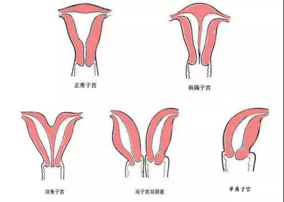 子宫畸形是怎么引起的？不同类型的子宫畸形和什么因素有关？