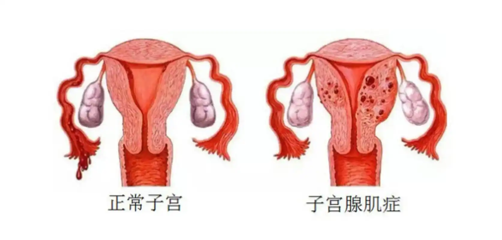 子宫腺肌症会导致流产吗？怀孕后要注意什么？