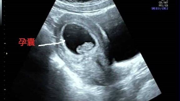 药流伤身,还是人流手术伤身?听听妇科医师怎么说 药流伤身,还是人流手术伤身?听听妇科医师怎么说